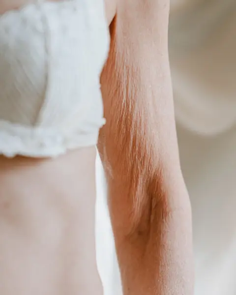 Flacidez (Bioestimuladores de Colágeno)